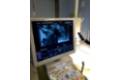 CANCER_PROSTATA_HURJC_1