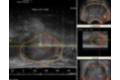 PROSTATA_Y_TUMOR2