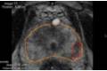 PROSTATA_Y_TUMOR